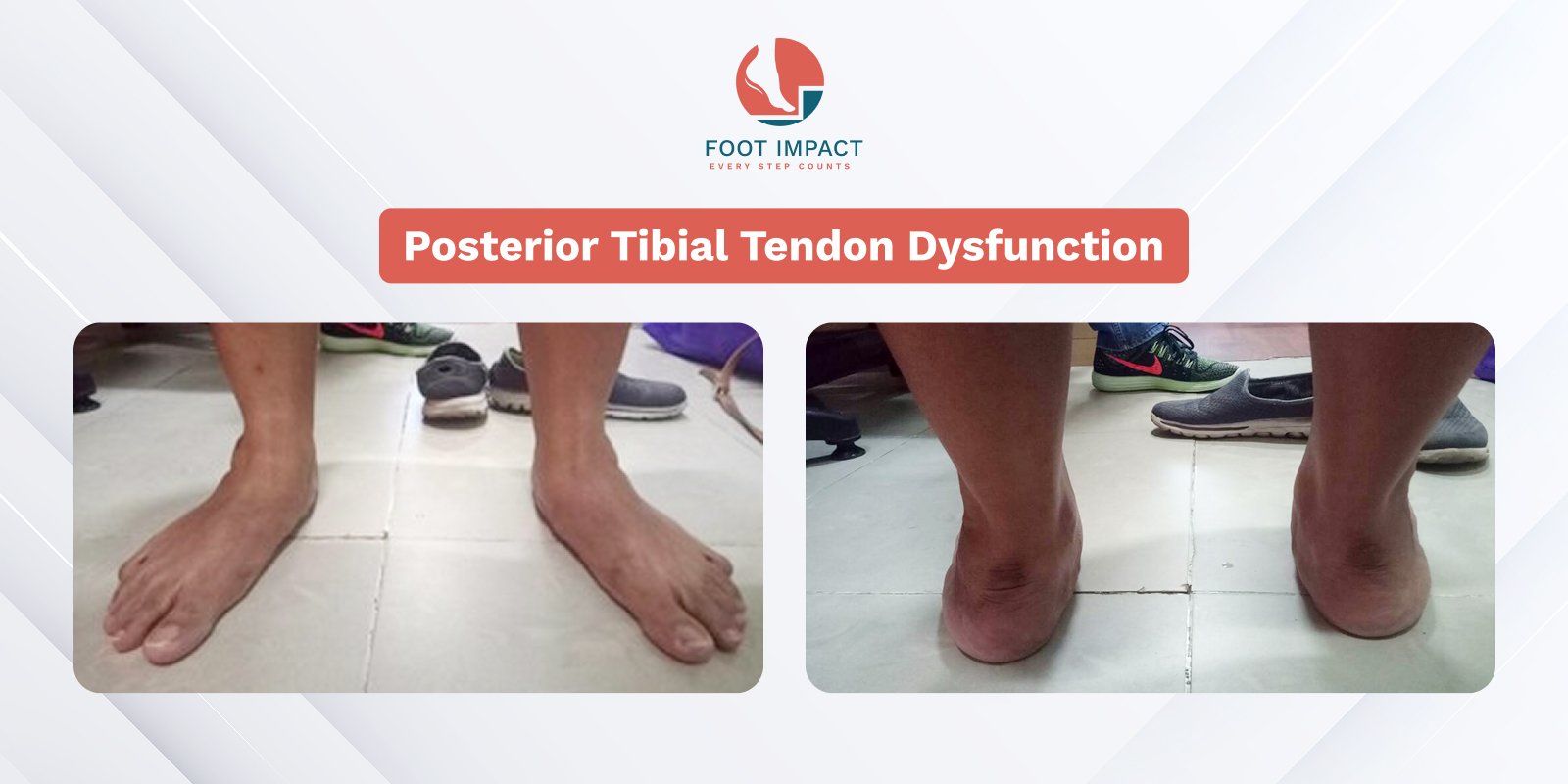 Transforming PTTD Recovery with Custom Orthotics and Footwear Correction